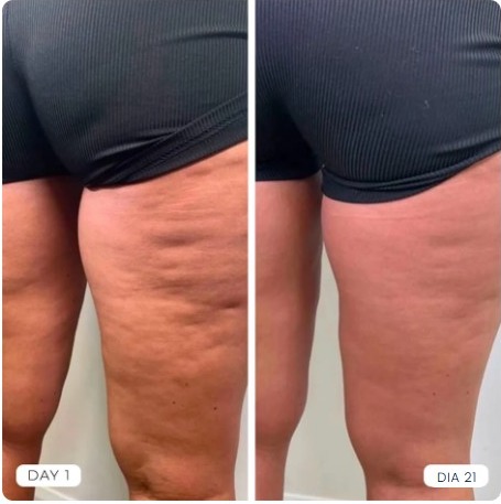 Comparação antes e depois — Amanda, 41