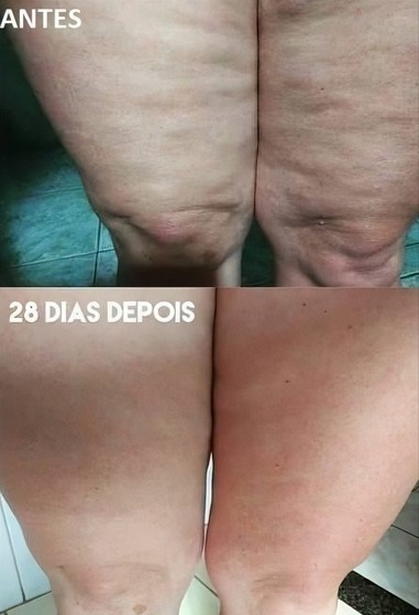 Foto de avaliação — Pernas — 28 dias depois